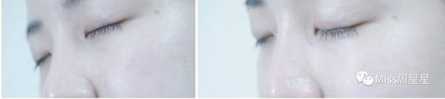 严重黑眼圈的治愈经历,千年黑眼圈解决方案