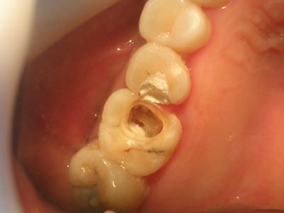 根管治疗牙痛还需要做吗,牙痛为什么要补牙