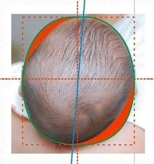 广州哪家医院可以矫正儿童头型,孩子头型问题