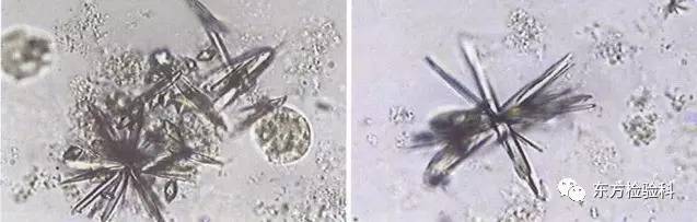 孕妇尿结晶数值多少是结石,尿结晶数量高看什么科