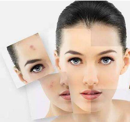 皮肤科医生推荐的淡化痘印方法,痘印顽固不化的原因