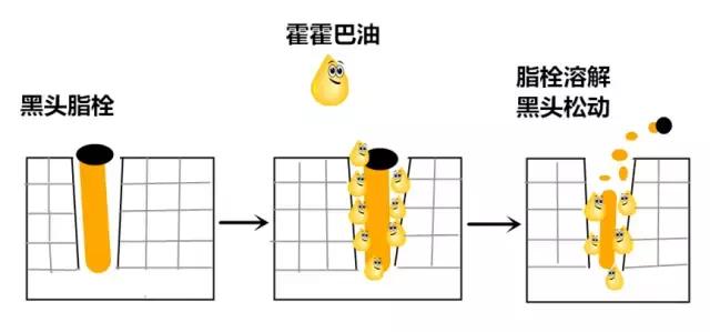 鼻子毛孔粗大有黑头怎么修复改善,女生毛孔粗大有黑头怎么改善医美