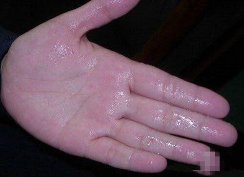 如何有效的抑制手掌出汗,手心容易出手汗怎么办