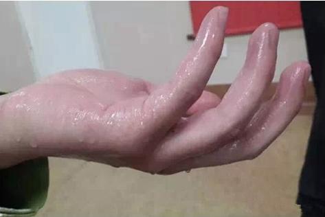 如何有效的抑制手掌出汗,手心容易出手汗怎么办