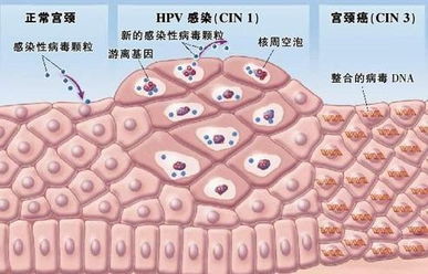 容易导致宫颈癌的hpv型号,妇科宫颈癌筛查和hpv检查费用多少