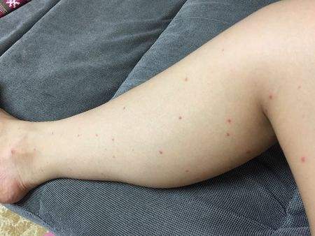身上长小红点不痛不痒变成黑点,身上长红点像红色小痣怎么回事