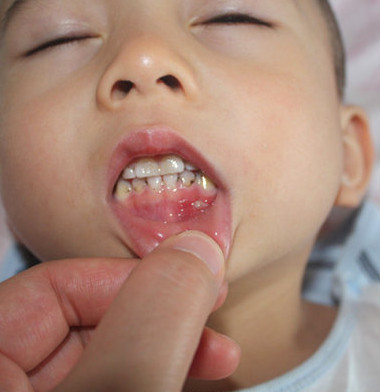 手足口病会传染成疱疹性咽峡炎吗,疱疹性咽峡炎还会感染手足口么