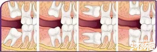 刚刚开始长智齿是什么样的,长智齿的症状有哪些你知道吗