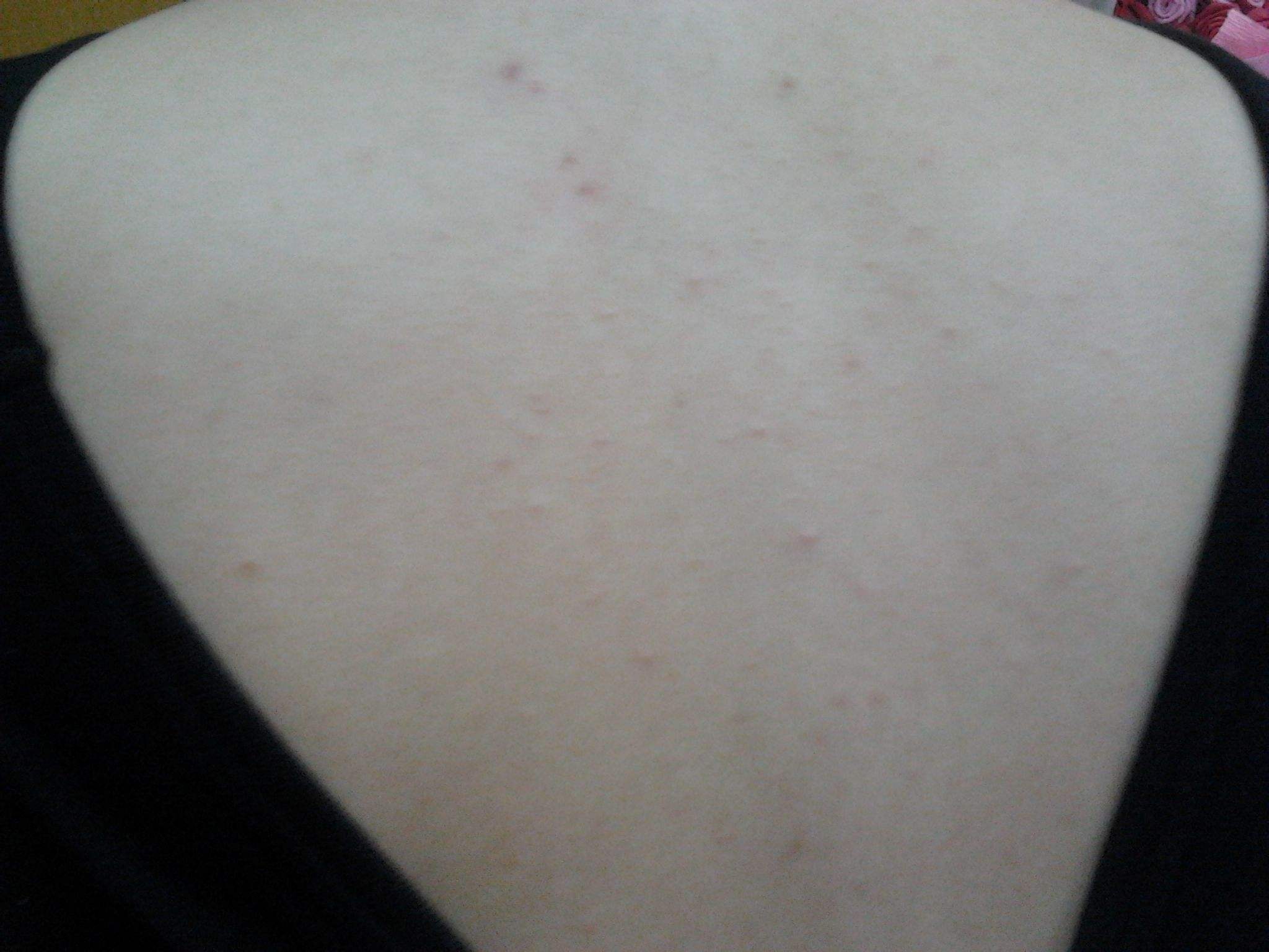 Freepure菲朴:背上长痘痘怎么办?7大杀招全解决