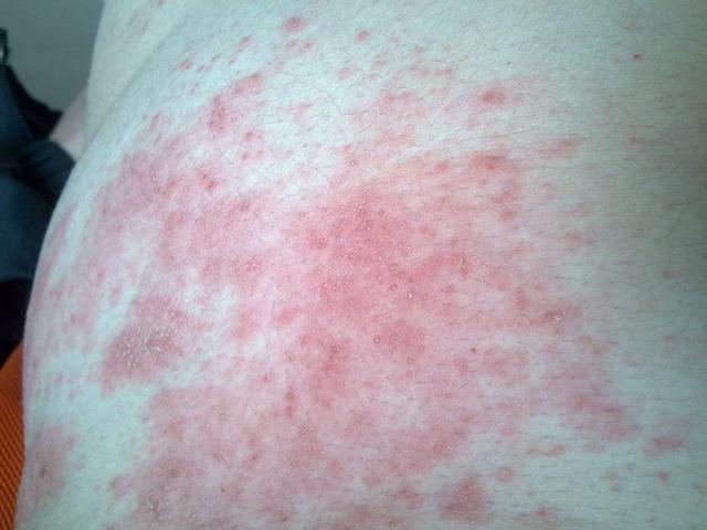 湿疹特别痒只能靠打针该怎么办,湿疹太痒了偏方