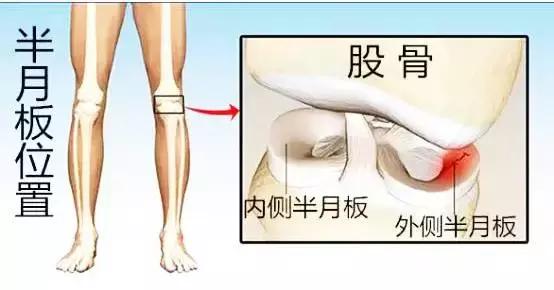 半月板左侧前角损伤最佳锻炼方法,膝关节半月板损伤2-3度怎样锻炼好