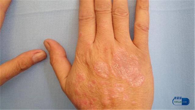 银屑病用卡泊三醇药膏,卡泊三醇治银屑病需要多久