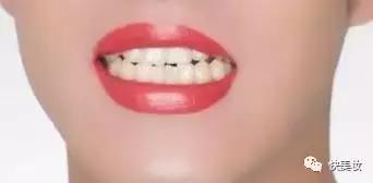 牙齿发黄是不是因为营养不良,牙齿黄被人嫌弃
