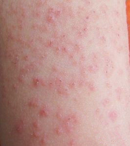 痒痒痒！得了*麻疹荨**怎么办？