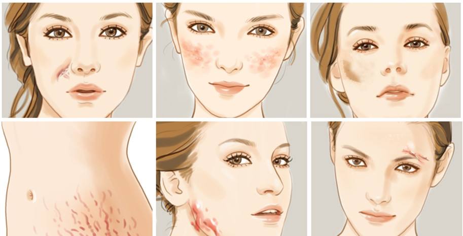 疤痕怎么能彻底消除效果图,疤痕怎么去除快速恢复小妙招