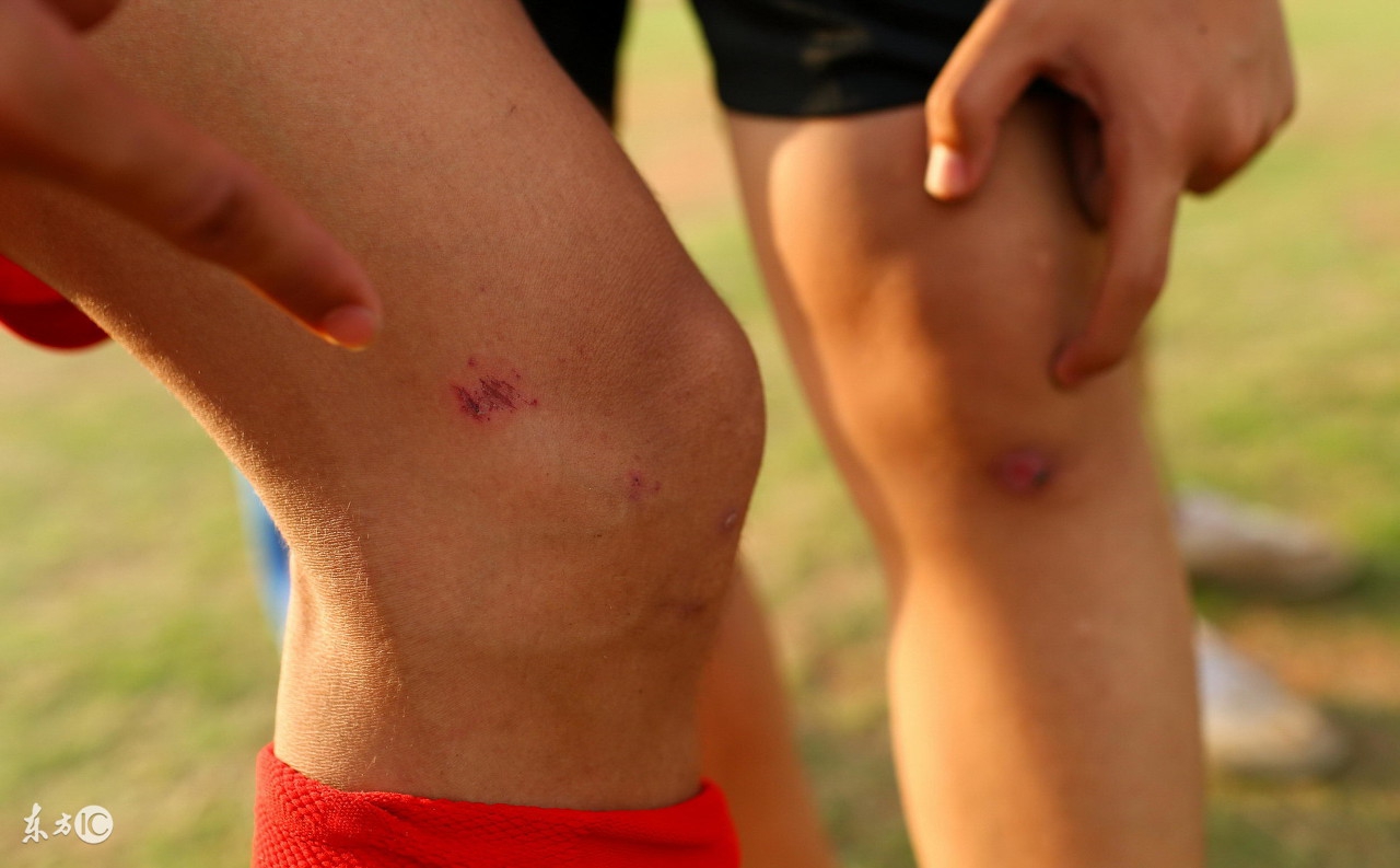 打球出现了骨折怎么处理,球场骨折