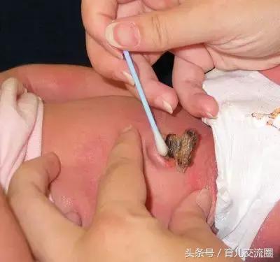 新生儿肚脐脱落前消毒视频,肚脐脱落后还要消毒多久