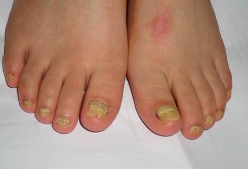 教你一招轻松根治灰指甲,灰指甲不可忽视教你如何正确处理