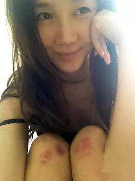 祛疤妙招—日本处方祛疤膏