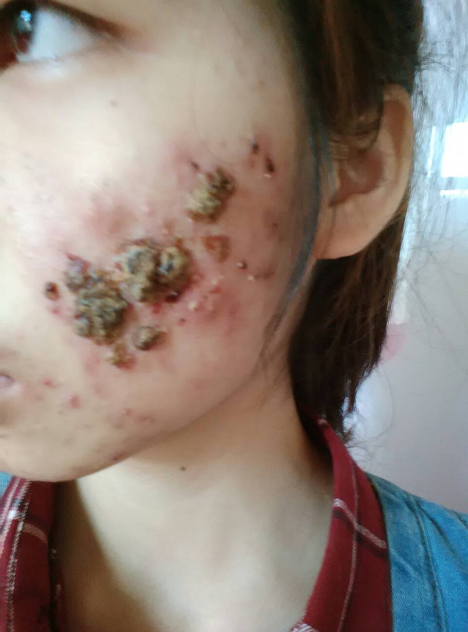 不做激光祛痘怎么去除痘印,不做医美怎么改善痘坑