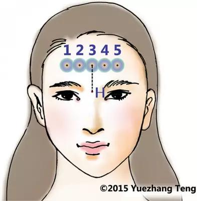 额部皱纹注射玻尿酸,额部注射除皱