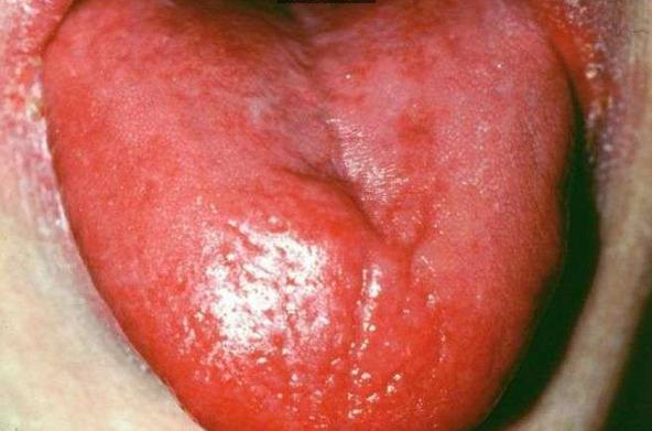 舌头有点皱证明什么,舌头边缘褶皱是什么原因