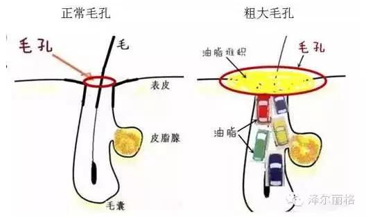 毛孔粗大收缩毛孔最有效的土方法,毛孔粗大怎么办教你快速收缩毛孔