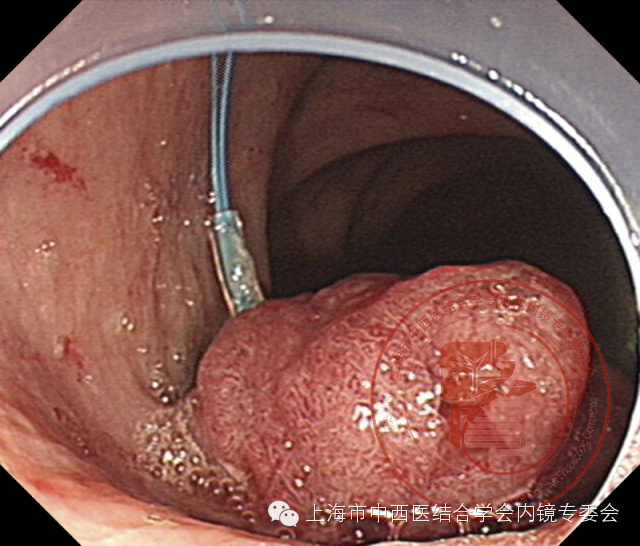 内镜套扎是什么,内镜套扎器械