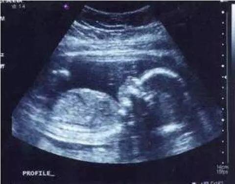 胎儿横位英文缩写,b超单上英文缩写代表什么