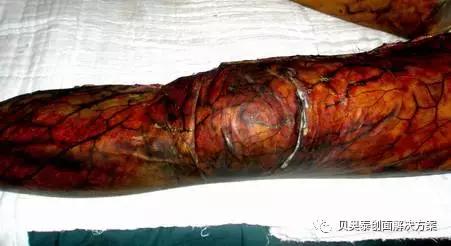 烧伤深度与临床表现图,氢氟酸烧伤的临床表现