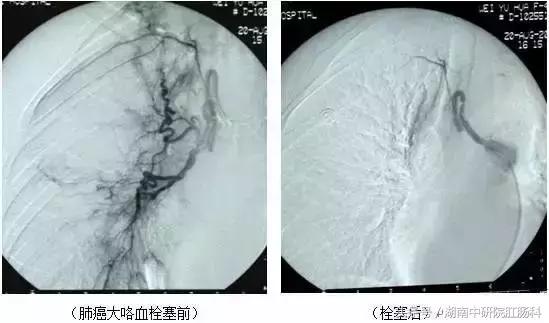 不可不知：六大肿瘤微创诊疗技术