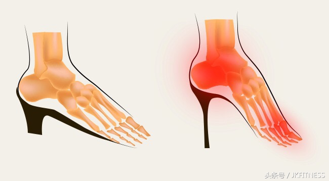 脚拇指外翻微创和复位哪种效果好,五十多岁了脚大拇指外翻能治愈吗