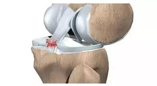 运动损伤怎么处理,运动软组织损伤怎么更快修复