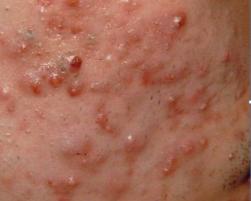 情绪不好出现皮肤病,情绪不稳定得皮肤病