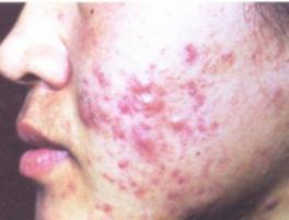 情绪不好出现皮肤病,情绪不稳定得皮肤病