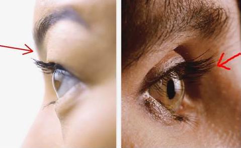 眼窝凹陷眼睛不舒服怎么办,眼窝凹陷要怎么才能好看