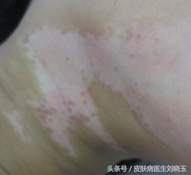 照308皮肤发红是好转吗,照了308几天皮肤还发红该怎么办