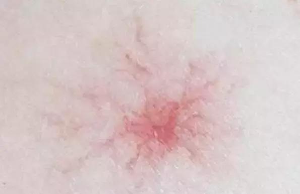 身上出的小红痣是什么原因造成的,身上出现小红痣是什么病症状