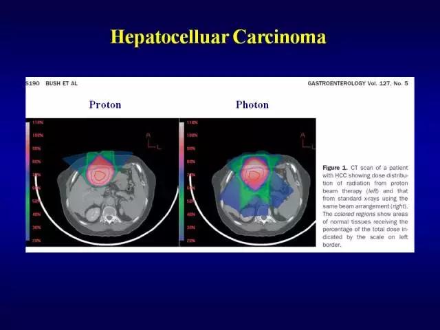 美国洛马林达质子治疗中心GaryYang：消化道肿瘤的质子放疗治疗