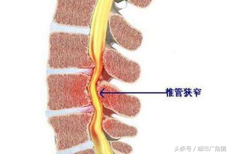 老年人腰椎管狭窄引起腿疼怎么治,七十六岁老人椎管狭窄疼得厉害
