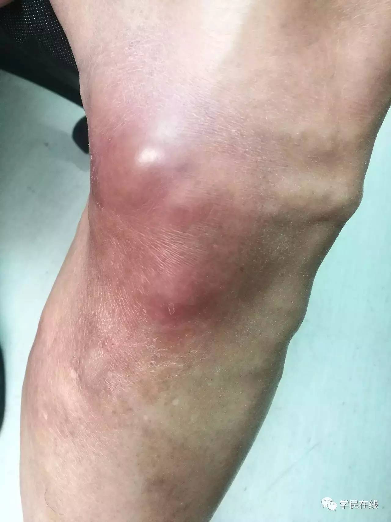 腿上长了这种包千万别瞎挤，小心猝死找上你！