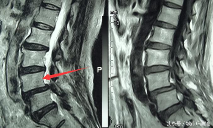 老年人腰椎管狭窄引起腿疼怎么治,七十六岁老人椎管狭窄疼得厉害