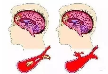 睡觉醒来手麻是什么原因和征兆,手麻的原因分析及简单评估