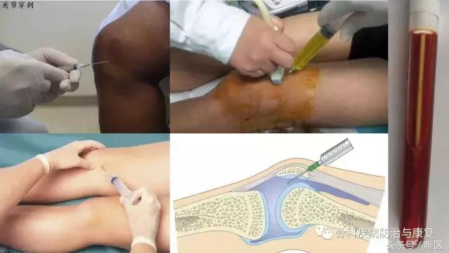 踝关节疼痛警惕四种病滑膜炎,关节炎滑膜炎的症状及治疗