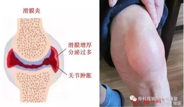 踝关节疼痛警惕四种病滑膜炎,关节炎滑膜炎的症状及治疗