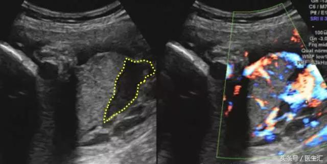 胎盘早剥病例课件,胎盘早剥的超声鉴别诊断
