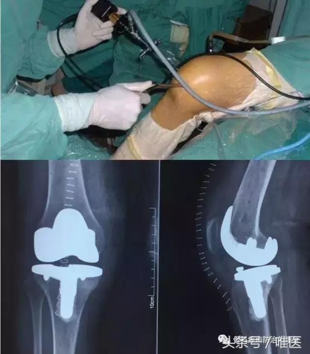 如何消除关节炎的肿胀积液,怎么确诊滑膜炎和膝关节炎