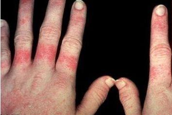 红斑狼疮记忆能恢复吗,红斑狼疮如何确诊