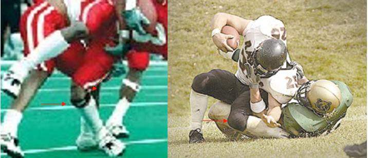 膝关节的急性损伤有哪些,膝关节侧韧带损伤症状