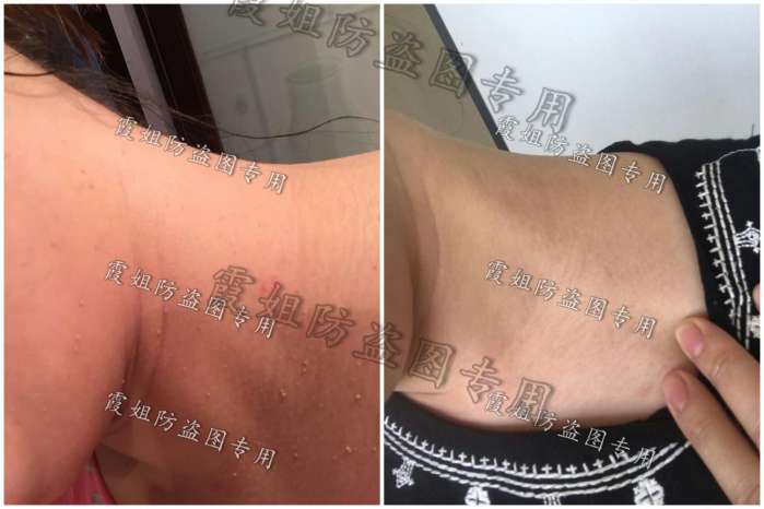 扁平疣|快去点掉你的扁平疣,别传染给我